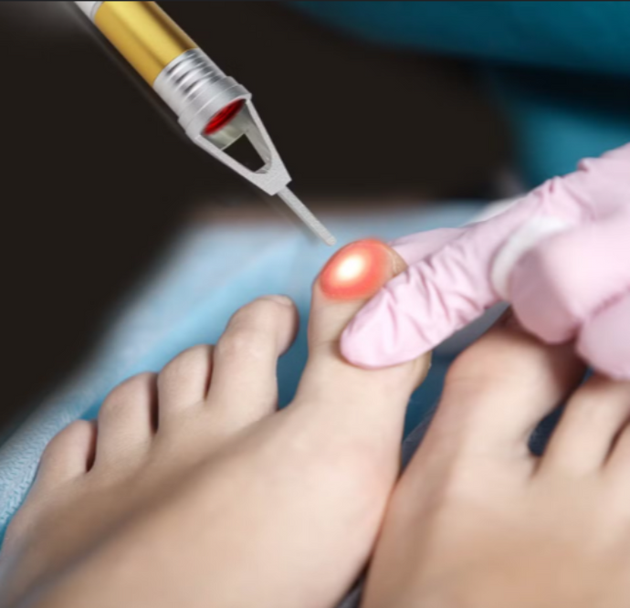 Pés - Laser 980nm - Uma vida sem fungos