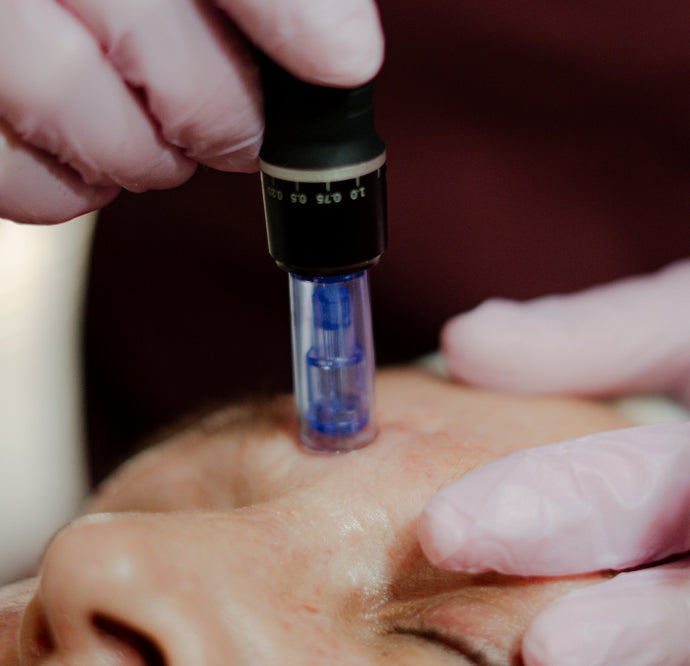 Rosto - Microneedling - Indução de Colagénio