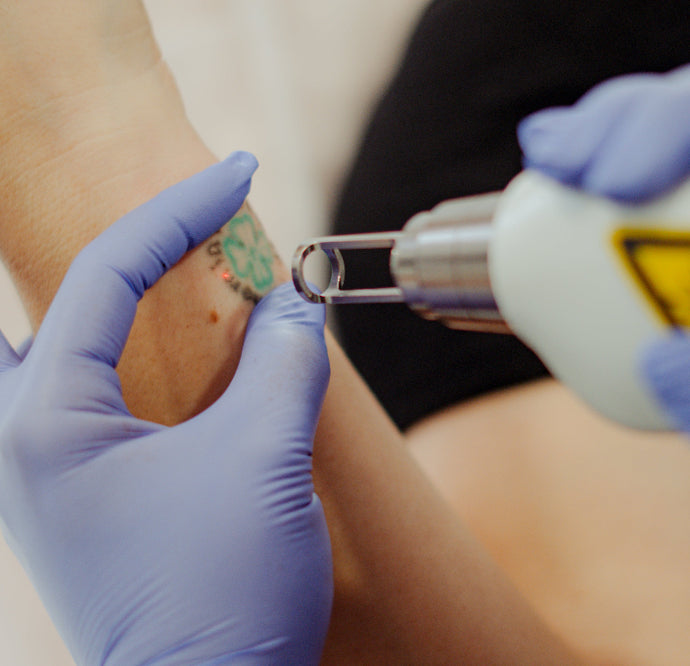 Rosto & Corpo - Laser YAG Tatto - Remoção de Pigmentos