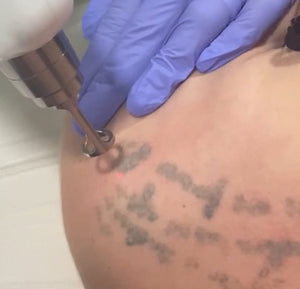 Rosto & Corpo - Laser YAG Tatto - Remoção de Pigmentos