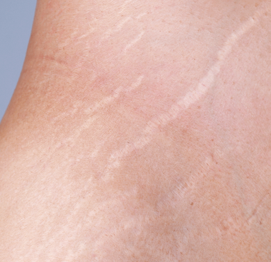 Formação Master Micropigmentação Paramédica ( Areola, Camouflagem, cicatrizes e estrias ) Brevemente