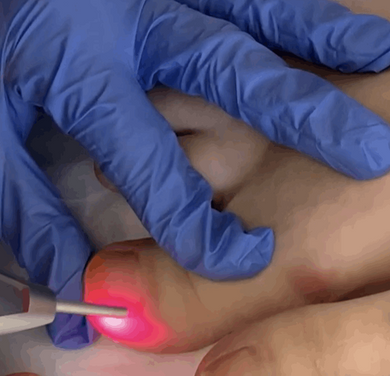 Formação Laser Diodo 980nm - Onicomicoses ( contacte-nos e mostre o seu interesse marcamos mediante a sua disponibilidade )